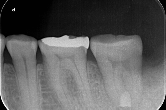 再生療法（歯の移植・再植） - 吉野歯科医院（八潮市八潮）
